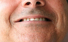 Full Porcelain Crowns (no metal) before 109209