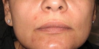 Juvederm after 272080