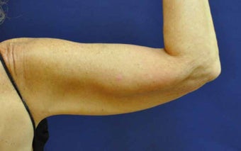 Liposuction Upper Arm after 513445