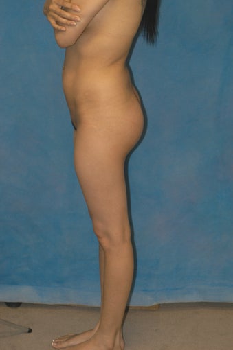 Women's Buttocks Augmentation after 518139