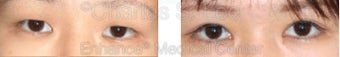 Blepharoplasty before 427698