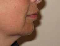 Injectables after 112085