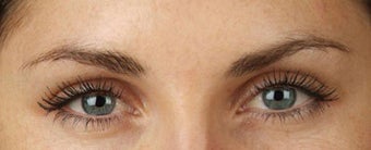 Botox after 391578
