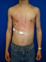 Pectus Excavatum, Chest Wall Reconstruction Surgery after 145940
