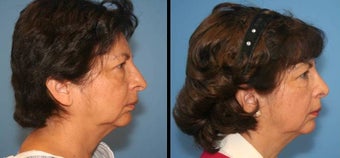 revision rhinoplasty before 442580