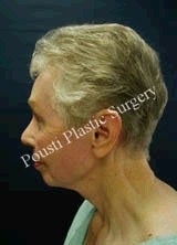 Chin Implants, Dermabrasion, Face Lift, Forehead Lift, Neck Lift 622586