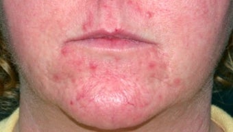 Vbeam for rosacea before 374537