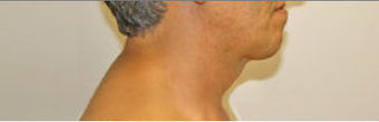 Chin Liposuction after 490761