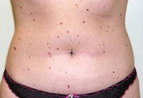 Liposuction before 200786