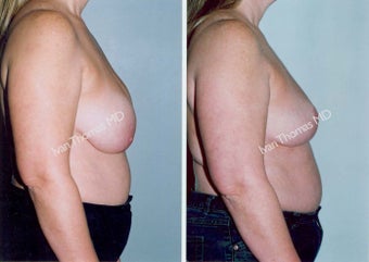Implant removal and Breast lift before 243649