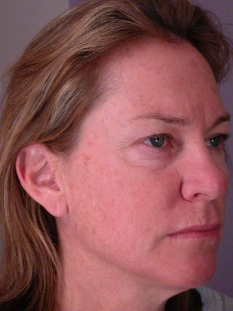 Neck Lift before 306407
