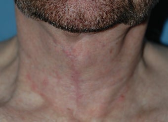 Neck Lift after 537418