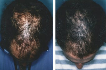 Medical treatment for hair loss (no surgery) before 369181