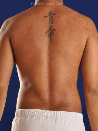 Vaser Hi Def Liposuction of the abdomen, chest, back, and flanks with fat injections to the pectoralis region after 422700