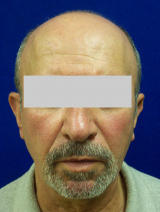 Ear Surgery (otoplasty) before 124910