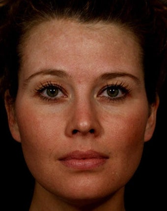 Sculptra after 317001