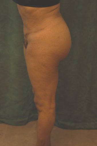 Women's Buttocks Augmentation after 518126