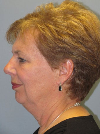 Neck Lift, Platysmaplasty 634747