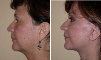 Necklift before 359779
