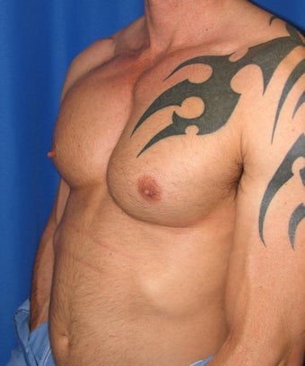 Pec Implants 420119