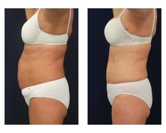 Abdominoplasty - Tummy Tuck 396160