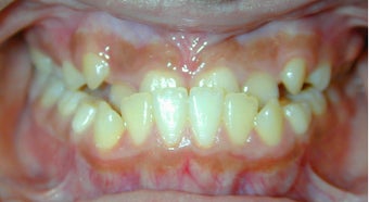 Teen Orthodontic Treatment (case #3MM) before 224584
