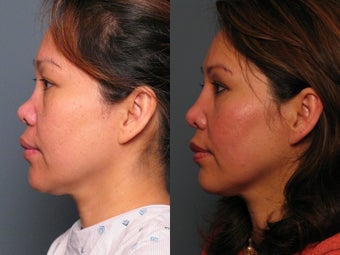 Nose Surgery 338486