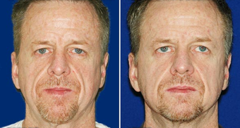 Sculptra before 496291