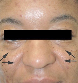 Treatment for Laugh lines before 93350