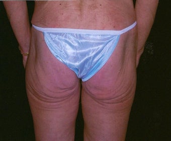 Buttock and flank lift for massive weight loss before 307428