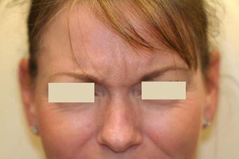 Botox before 93217