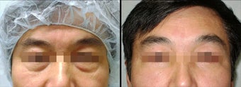 Lower Eyelid(Blepharoplasty) Surgery before 650696