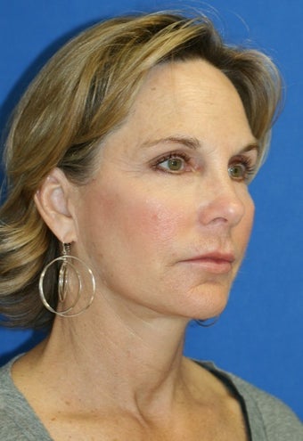 face Lift 367610