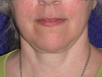 Necklift after 208456