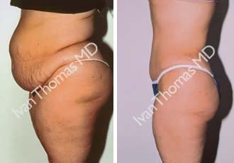 Tummy Tuck before 242521