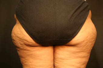 Cellulite Treatment before 602206