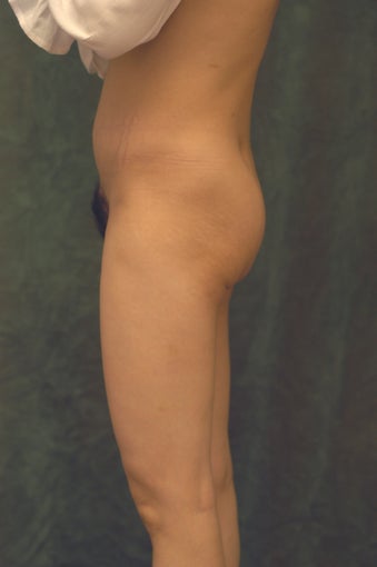 Women's Buttocks Augmentation before 518116
