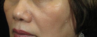 Cheek Lift / Augmentation before 352885