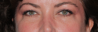 Restylane after 596242