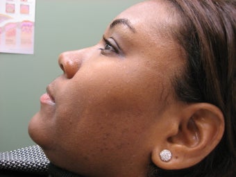 DPN removal after 286462