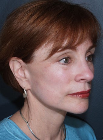 Vertical Facelift after 113262