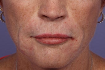 Radiesse and Juvederm - Smile lines after 309227