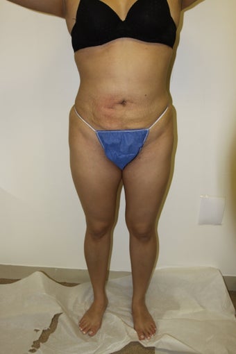 Brazilian Butt Lift after 481680
