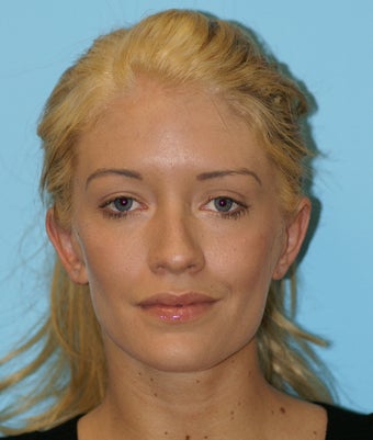 Otoplasty after 574622