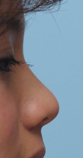 Non Surgical Rhinoplasty before 393833