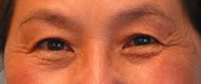 Asian Eyelid Surgery before 613747
