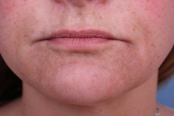Evolence Collagen for Marionette Lines and Chin after 114168