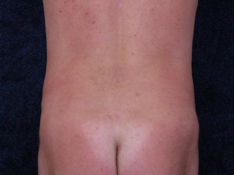 Liposuction to the waist and hips. 396363