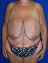 Surgery After Massive Weight Loss before 131829