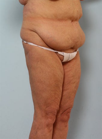 Body Lift before 260124